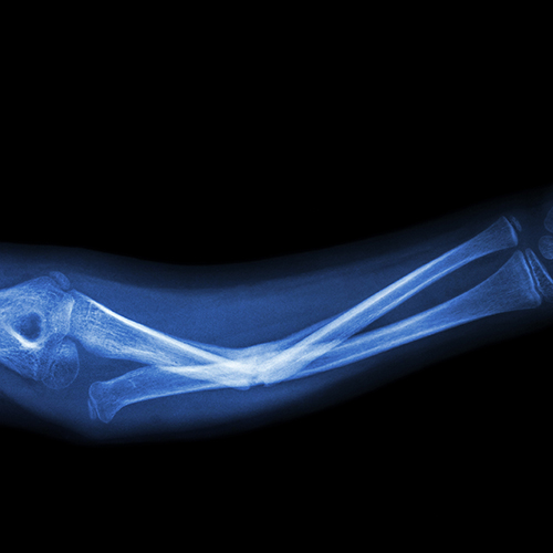 Fracture