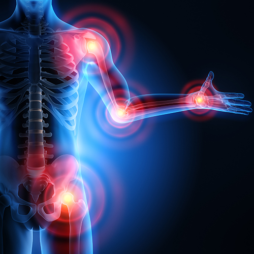 Osteoarthritis