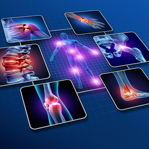 Rheumatoid Arthritis
